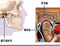 顳下頜關節(jié)紊亂病